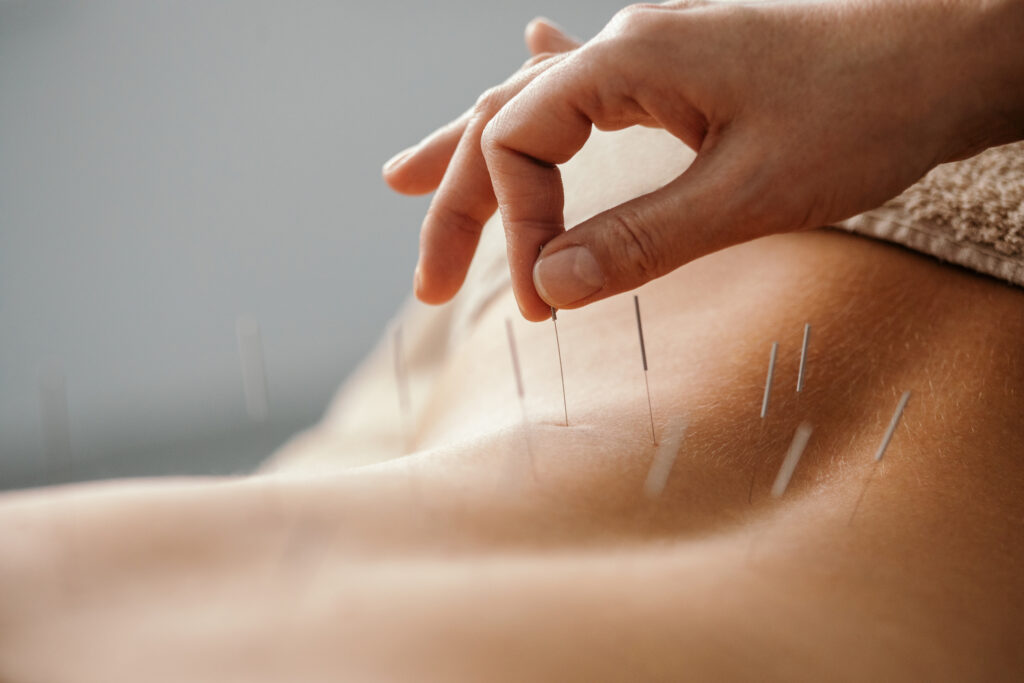 Akupunktur und TCM